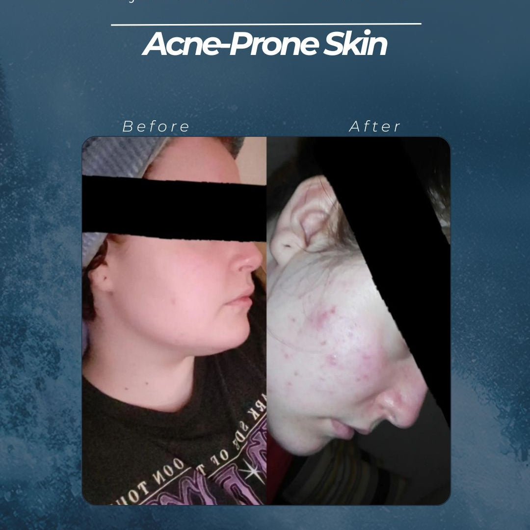 Jojoba and Tea Tree Facial Oil for Acne-Prone Skin: A Natural Two-Ingredient Fix