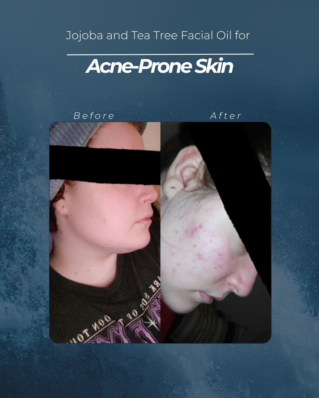 Jojoba and Tea Tree Facial Oil for Acne-Prone Skin: A Natural Two-Ingredient Fix