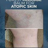 Forest Microbe Balm for Atopic Skin, Eczema-Prone Skin and Skin Barrier Repair