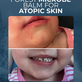 Forest Microbe Balm for Atopic Skin, Eczema-Prone Skin and Skin Barrier Repair