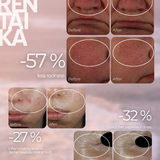 Redness Relief Serum for Rosacea, Couperose and Reactive Skin