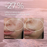 Redness Relief Serum for Rosacea, Couperose and Reactive Skin