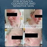 Sea Buckthorn Soap for Rosacea-Prone, Couperose and Sensitive Skin