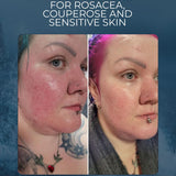 Sea Buckthorn Soap for Rosacea-Prone, Couperose and Sensitive Skin