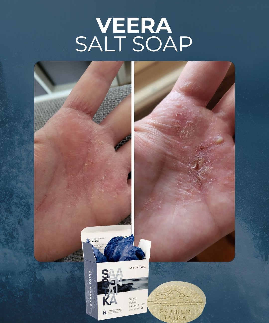 Veera Salz- und Haferseife bei Psoriasis, atopischer Haut, Juckreiz und Körpergeruch